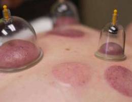 Hijama, leech therapy, cupping therapy